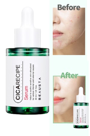 Beruhigendes Anti-Akne-Serum mit Cica Centella für empfindliche Haut TYC6S5XHLN168673904909441 - 1