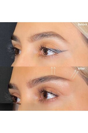 Facelift-Tape – dünnes Tape (schwarz) – geeignet für wiederholten Gebrauch / ultrastarkes Facelift-Tape mit Botox-Effekt - 5