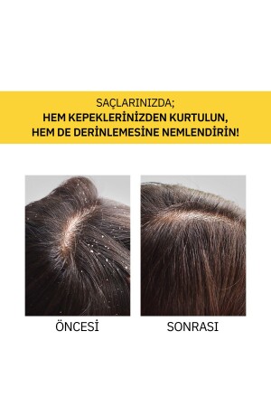 Piroctone Olamine Kepeklenmeyi Önlemeye Yardımcı Saç Bakım Serumu 100ml - 6