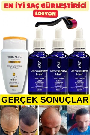Saç gürleştirici - sac - sac bakimi -sac serumu - sac serum ve yagi - sac - 3 Adet-Roller-Şampuan - Dermanew Hair