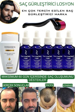 Saç Gürleştirici Serum Roller Mavi Şampuan Hediyeli - -5x50ml - Dermanew Hair