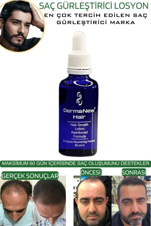 Saç Gürleştirici Serum Roller Mavi Şampuan Hediyeli - -5x50ml - 6